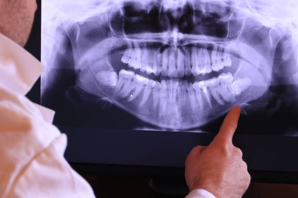 Best Emergency Treatment for Dental Infections or Abscesses in Spring House, PA